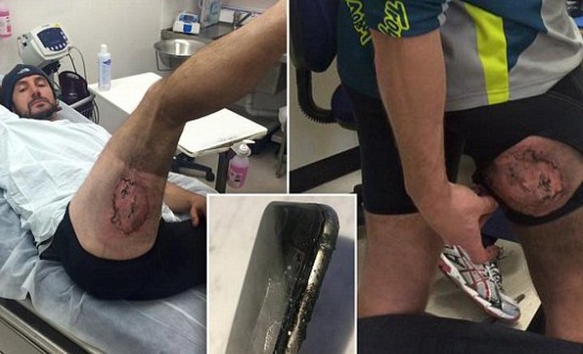 Biciklista zadobio opekotine trećeg stepena nakon što mu je eksplodirao iPhone u stražnjem džepu