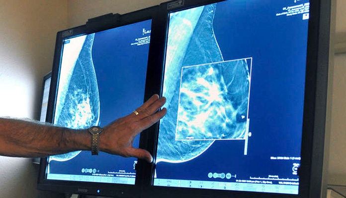 Besplatni mamografski pregledi u ZDK i ove godine